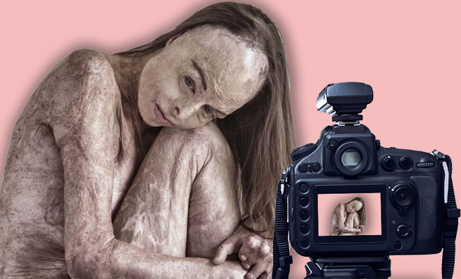 Carol Mayer, Burn Survivor And Former Beauty Queen, Sends A Powerful Message With Her Nude Portrait
