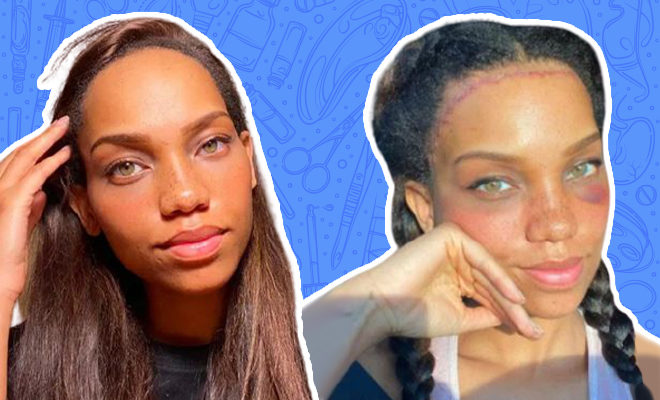 This Model Spent Lakhs On Surgery That Would Shorten Her Forehead By A Mere 3 Centimetres