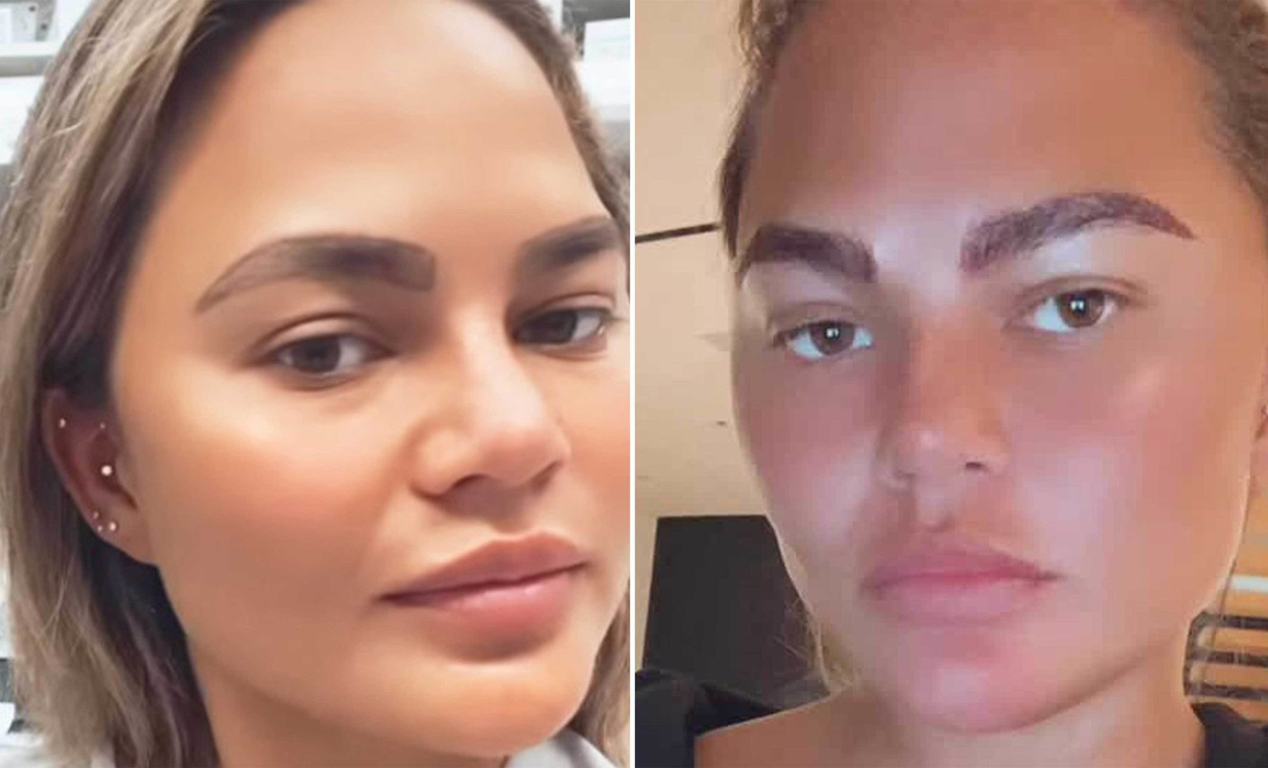 All You Need To Know About Chrissy Teigen’s Eyebrow Transplant Surgery!