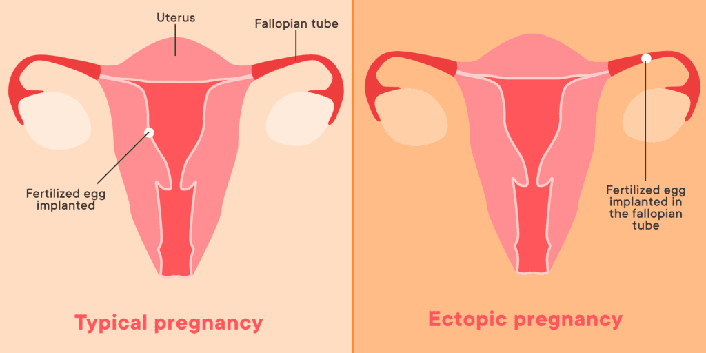 What Is An Ectopic Pregnancy And How Does The US Abortion Ban Affect Such Cases? What Is An Ectopic Pregnancy And How Does The US Abortion Ban Affect Such Cases?