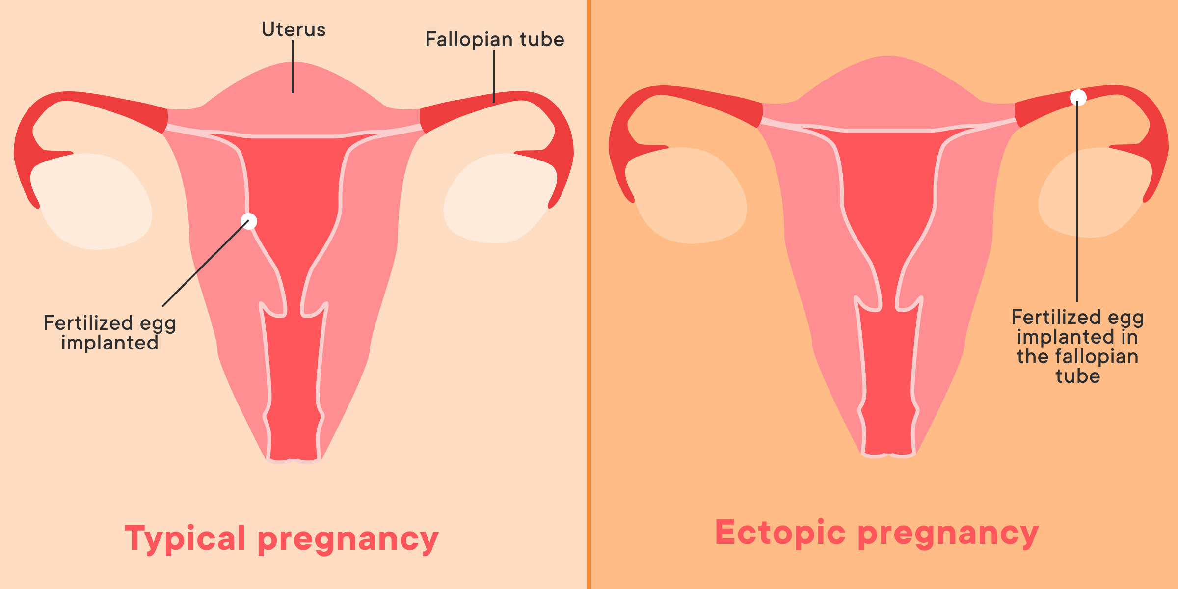What Is An Ectopic Pregnancy And How Does The US Abortion Ban Affect Such Cases?