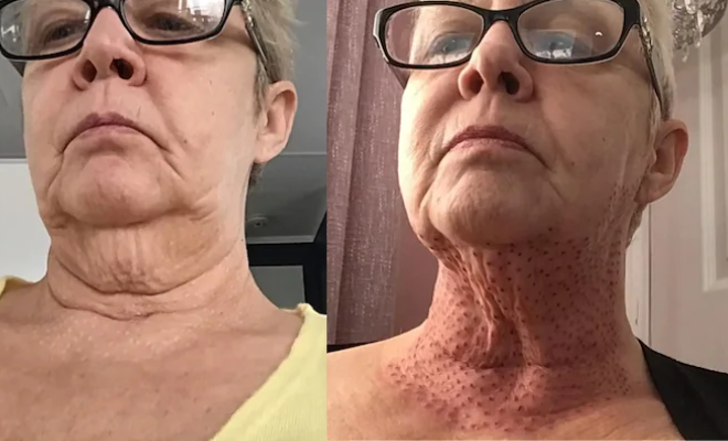 Woman Left With ‘Lizard Neck’ After Cosmetic Procedure To Fix Double Chin Goes Wrong