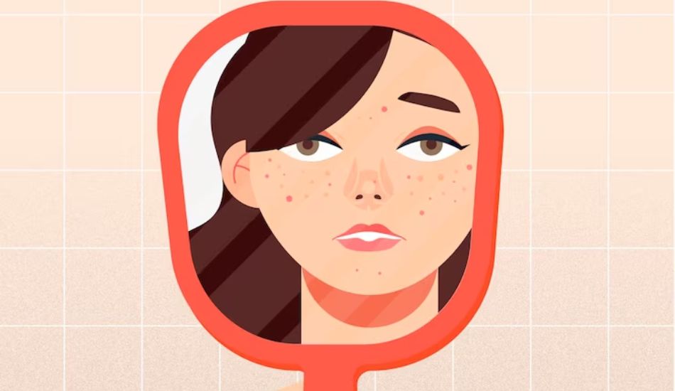 Why-Do-We-Get-Acne-Before-Important-Events-Hormones-Sleep