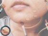 The Ultimate Guide To Using Concealer For Acne-Prone Skin