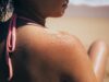 How To Treat Sunburn? 8 Hacks You Need To Bookmark This Summer