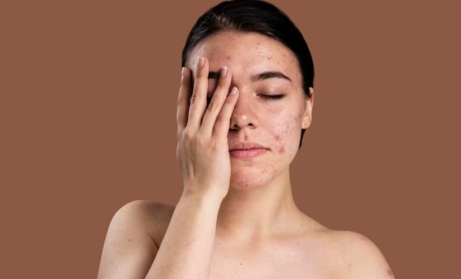Inflamed-Skin-Skincare-Hacks-For-Instant-Relief-Cold-Compress-Sunscreen
