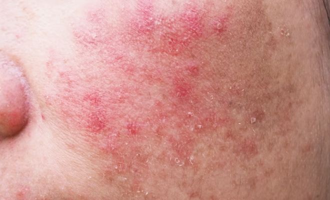 Inflamed-Skin-Skincare-Hacks-For-Instant-Relief-Cold-Compress-Sunscreen