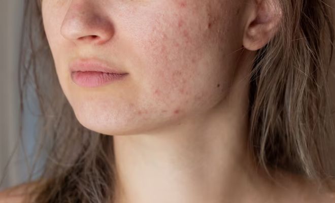 Inflamed-Skin-Skincare-Hacks-For-Instant-Relief-Cold-Compress-Sunscreen