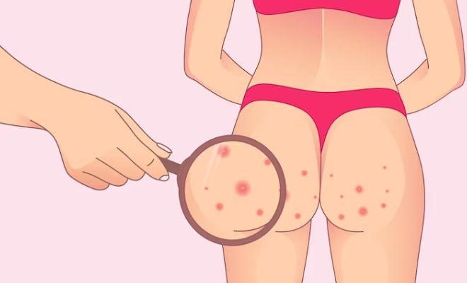 How-To-Get-Rid-Of-Bacne-Butt-Acne-Shower-Breathable-Clothes