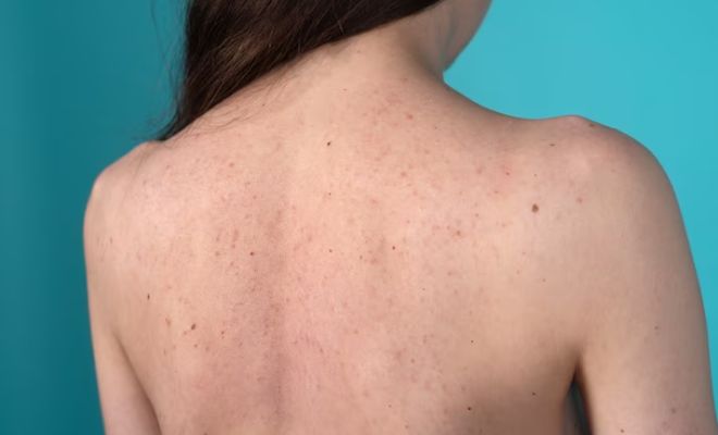 How-To-Get-Rid-Of-Bacne-Butt-Acne-Shower-Breathable-Clothes