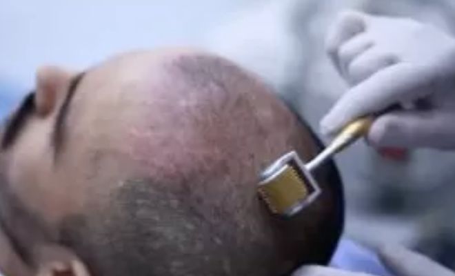 Dermatologist-Take-On-Micro-Needling-Hair-Growth-Glowing-Complexion
