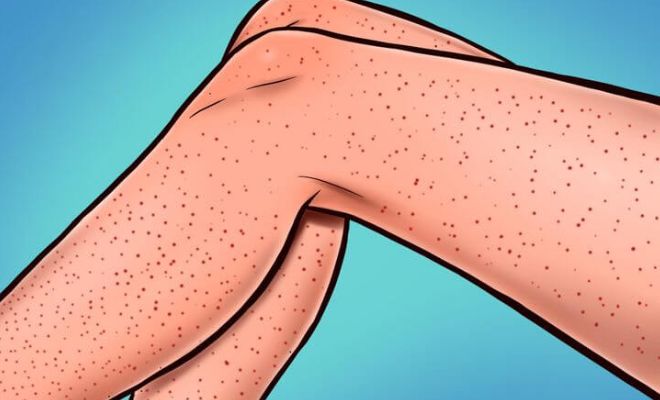 how-to-deal-with-strawberry-legs-smooth-skin-exfoliate-warm-compress