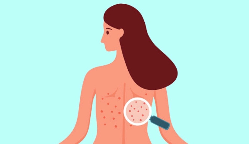 Want Smooth Skin Everywhere? Say Goodbye to Bacne and Butt Acne with These Tips