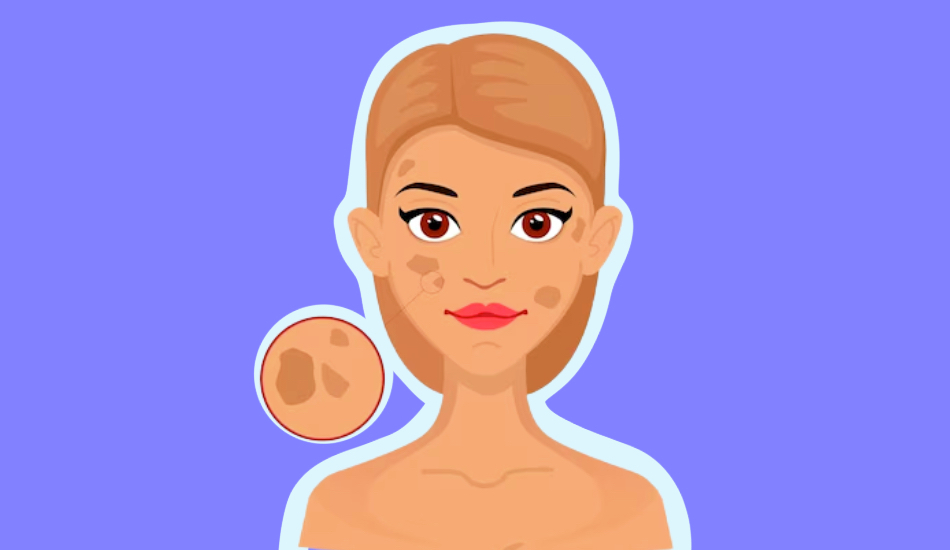what-is-hypopigmentation-skin-condition-less-melanin
