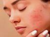Got Inflamed Skin? Try These Skincare Hacks For Instant Relief