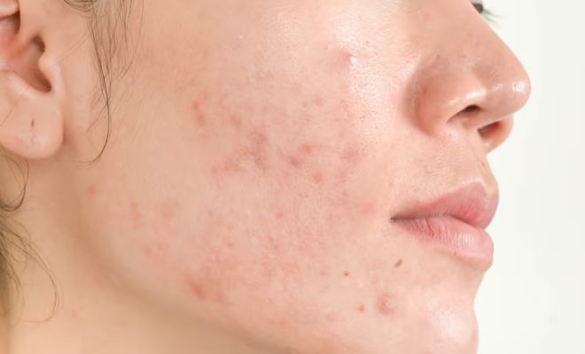 Why-Face-Bleaching-Is-A-Bad-Ideas-Sensitive-Skin-Chemicals