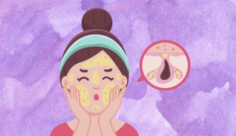 why-do-certain-products-cause-skin-congestion-comedogenic-reaction-on-skin-how-to-deal-with-it