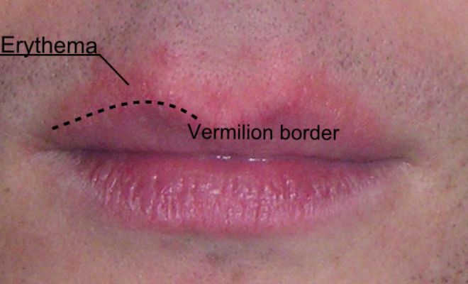 What-Are-Vermillion-Border-Lips-Causes-Defined-Look