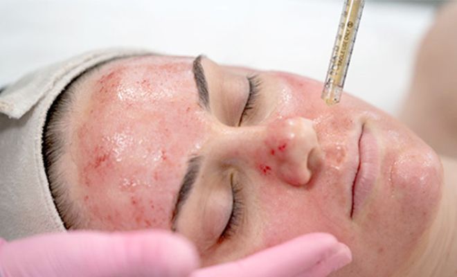 What-Is-The-Vampire-Facial-Expert-Dermatologist-Explains-Rejuvenate-Skin-Acne-Scars-Pigmentation