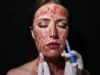 What Is The Vampire Facial Everyone’s Obsessed With? Expert Dermatologist Explains