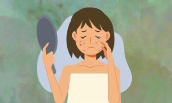 different-areas-of-acne-breakout-on-face-reasons-behind-it-hormonal-dirt