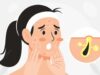 Have You Considered These 3 Ingredients In Your Quest To Eliminate Blackheads?
