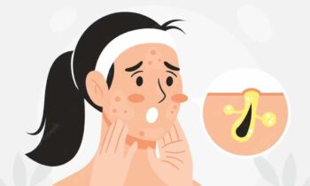 what-skincare-ingredients-use-get-rid-of-blackheads-closed-comedones-salicylic-acid