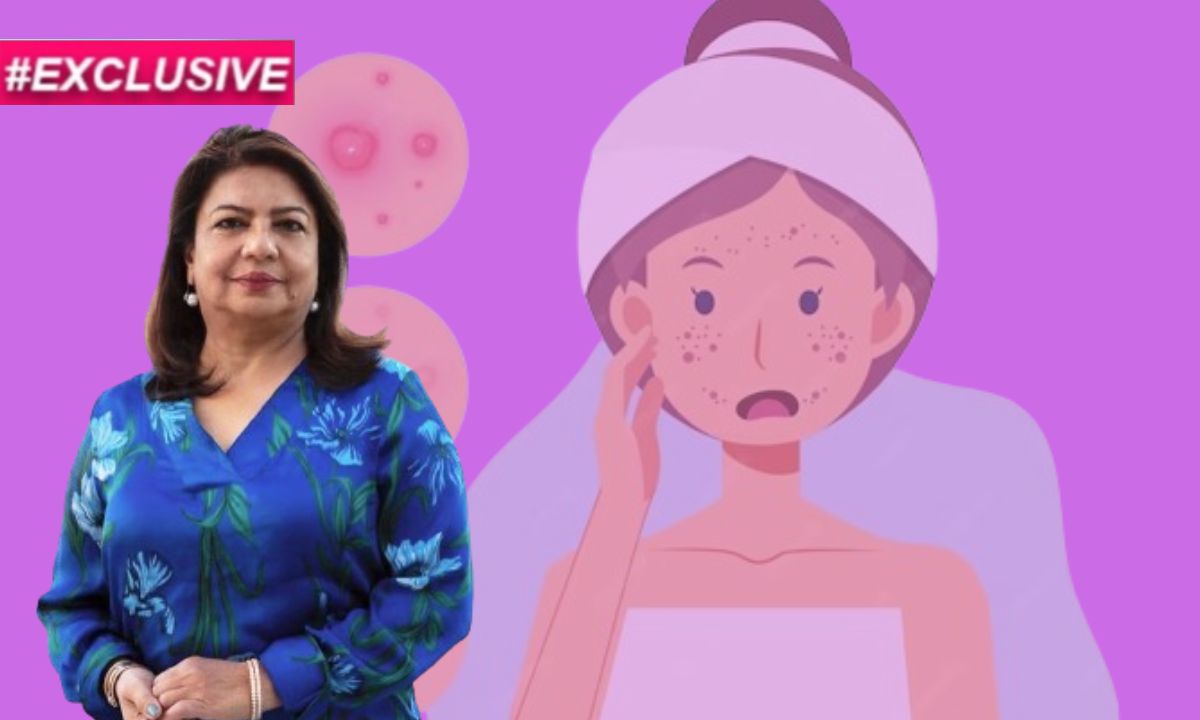 Exclusive: Dr Madhu Chopra Shares Easy Tips For Teenagers To Manage Acne