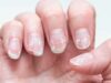 Dermatologist Reveals 3 Common Mistakes To Avoid For Healthy Nails!