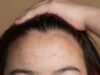 From Causes To Treatment, Here’s Your Ultimate Dermatologist Approved Guide To Deal With Forehead Acne!