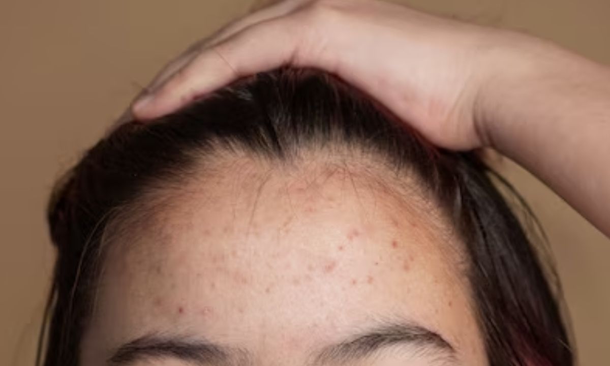 From Causes To Treatment, Here’s Your Ultimate Dermatologist Approved Guide To Deal With Forehead Acne!