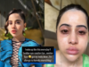 Uorfi Javed Shares Pics Of Swollen Eyes And Face: “I Wake Up Like This Everyday, I’m Allergic To Literally Everything”