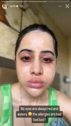 uorfi-javed-instagram-stories-allergies-face-eyes-fashion-clothes-video-swollen