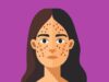 Skincare Expert Shares Beauty Tips To Get Rid Of Hyperpigmentation And We’re Here For It!