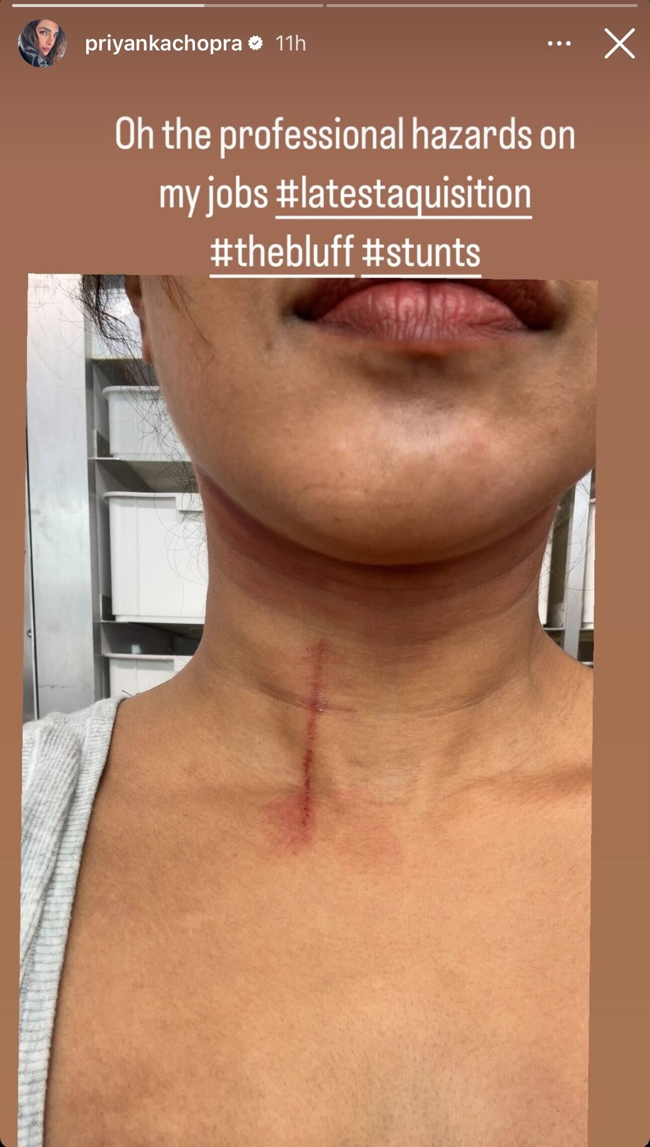 Priyanka Chopra Injured While Shooting For The Bluff With Karl Urban: "Professional Hazards Of My Job"