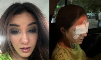 Jasmin-bhasin-suffers-corneal-damage-due-to-lenses-cant-see-pain