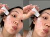 Girls Are Taking Sweet Treats To Next Level And Treating Their Acne Prone Skin With Powdered Sugar