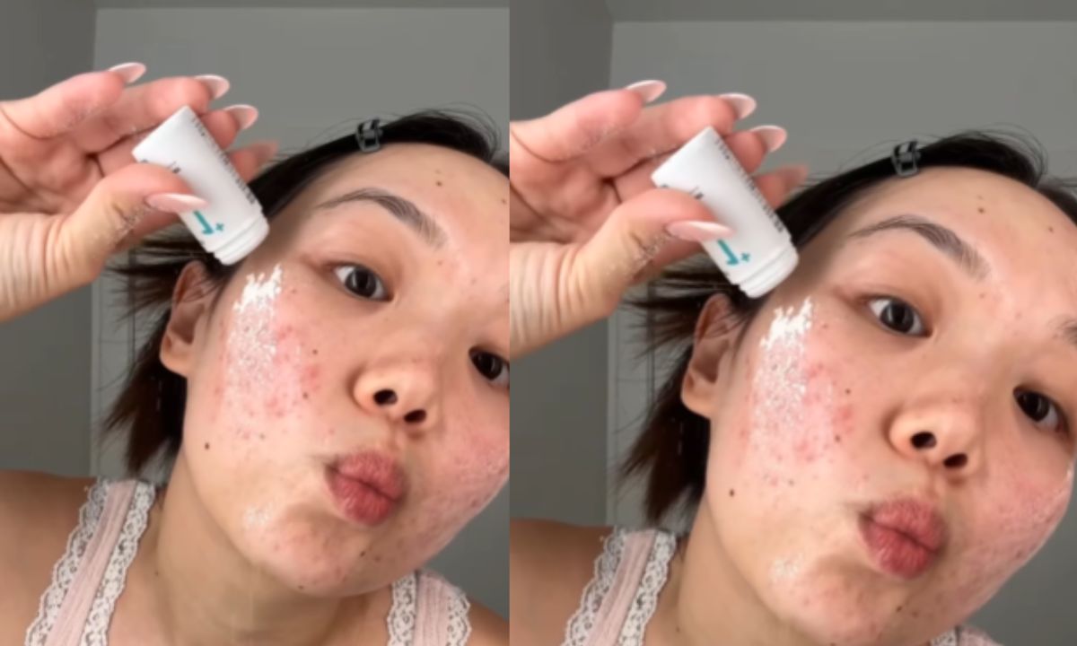 Girls Are Taking Sweet Treats To Next Level And Treating Their Acne Prone Skin With Powdered Sugar Girls Are Taking Sweet Treats To Next Level And Treating Their Acne Prone Skin With Powdered Sugar