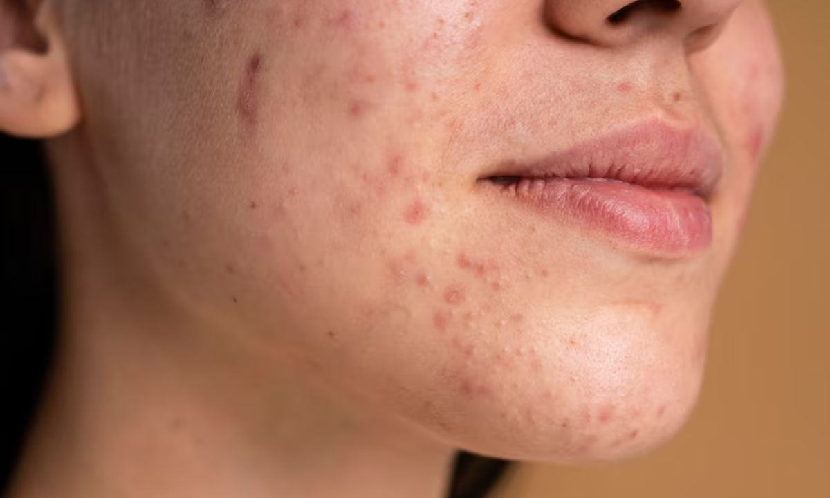 What Should Be The Ideal Summer Skincare Routine For Acne-Prone Skin? We’ve Got Details! What Should Be The Ideal Summer Skincare Routine For Acne-Prone Skin? We’ve Got Details!
