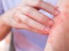 How To Care For Eczema-Prone Skin In Summer? 5 Hacks To Know