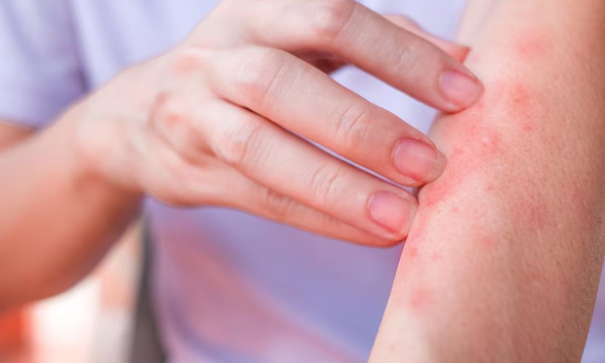 How To Care For Eczema-Prone Skin In Summer? 5 Hacks To Know