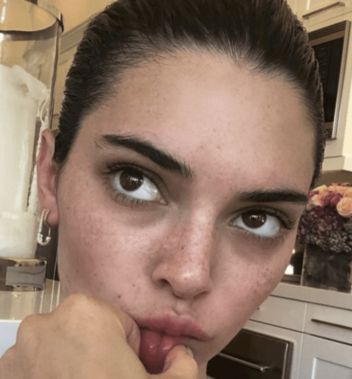freckles 